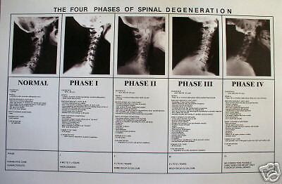Chiropractic phases of spinal degeneration poster
